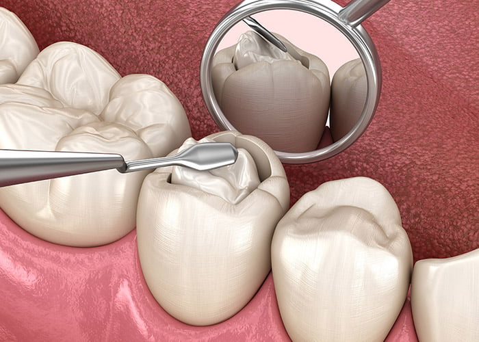 Average Cost of Tooth Filling- How much tooth filing cost in Los Angeles