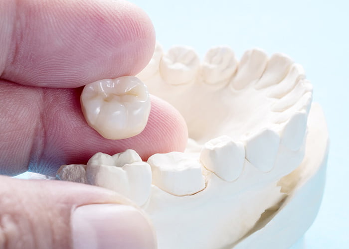 Advantages of Dental Crowns