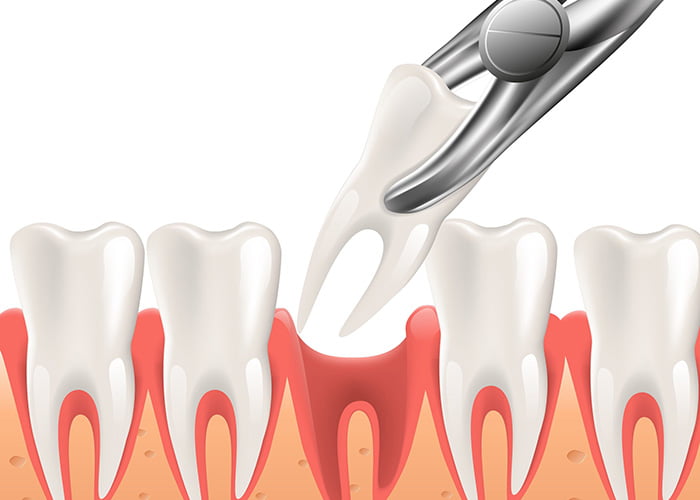What is tooth extraction?