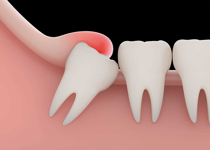 Wisdom tooth extraction recovery