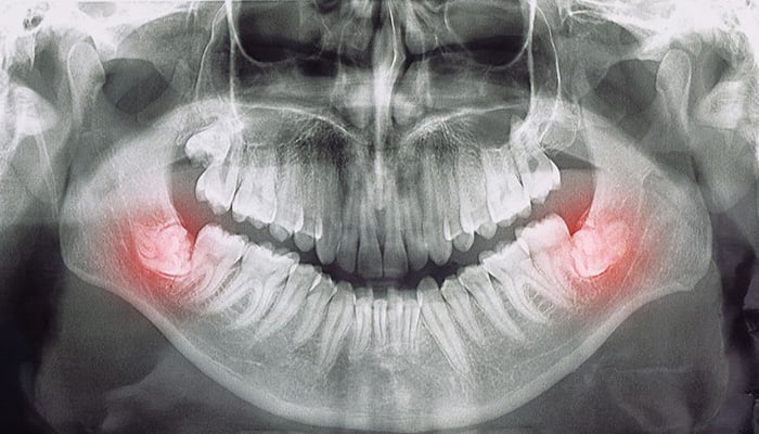 Wisdom tooth extraction pain