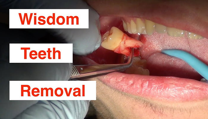 Is Wisdom Tooth Removal Painful?