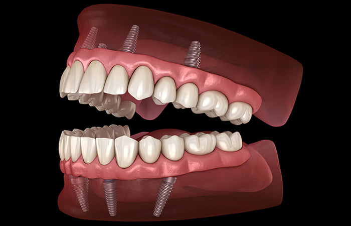 Dental implant full mouth cost