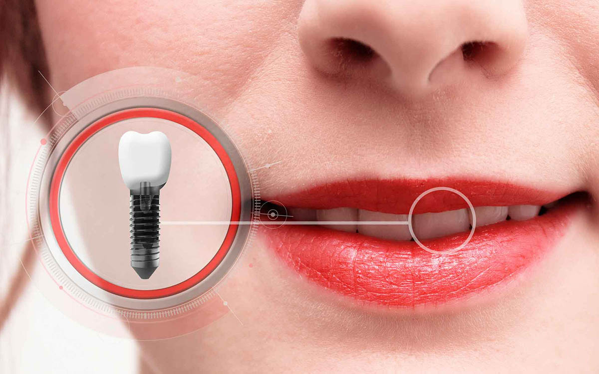 Is dental implant painful