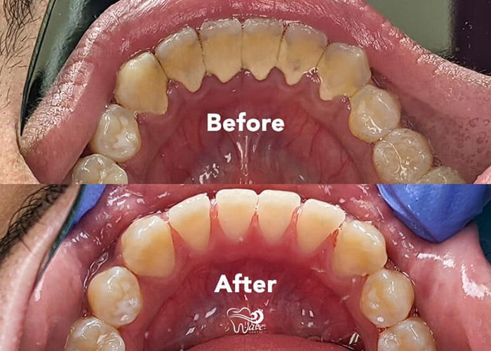 Deep Cleaning Tooth Cost1 