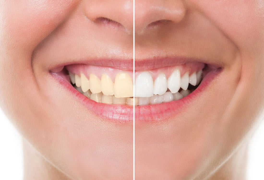 Can Teeth Fall Out After Getting a Deep Cleaning?