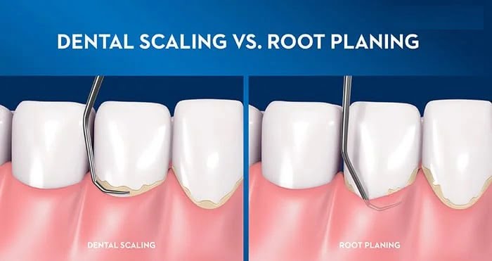 Scaling and root planing