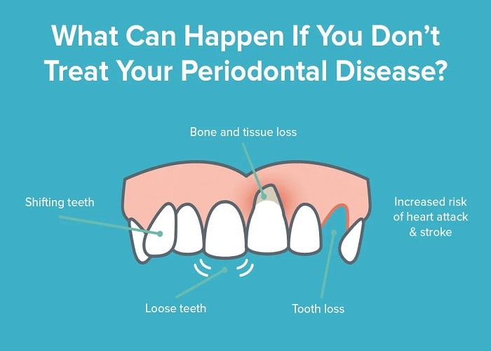 Periodontal (gum) disease