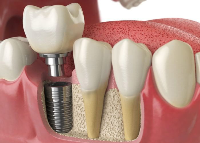The Average Cost of Dental Implants