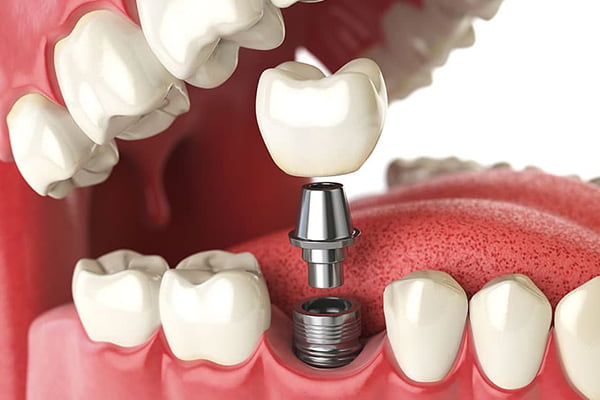 Single Tooth Implants