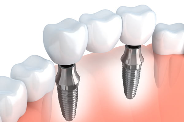 Implant-Supported Bridgework