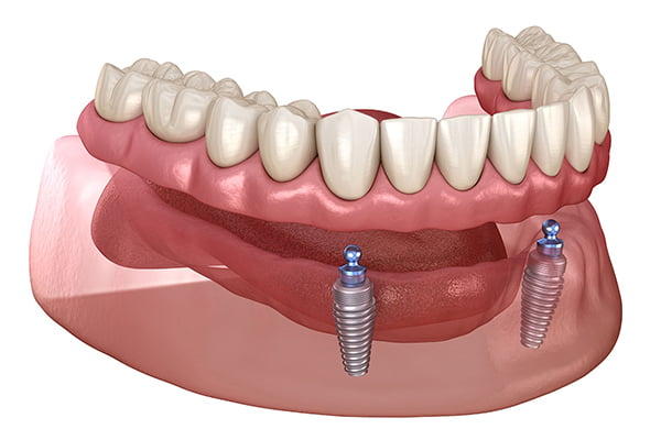 Implant-Supported Dentures