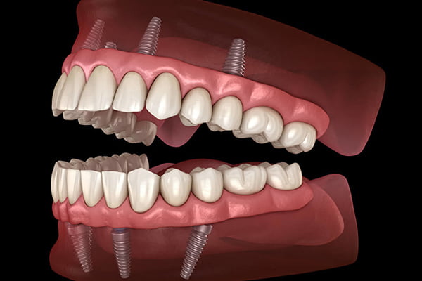 All-On-Four Dental Implants