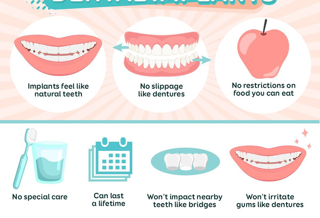 Dental implant benefits