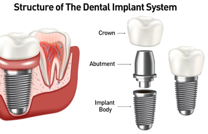 The dental implant abutment