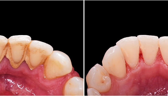 What are the disadvantages of deep cleaning teeth?