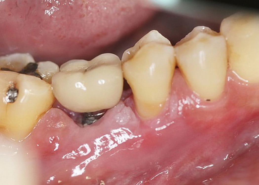Disadvantages of dental implants