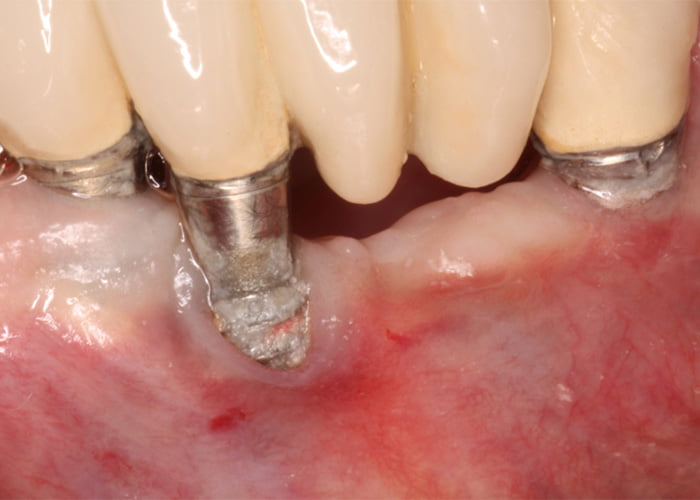 What are the downsides of dental implants?