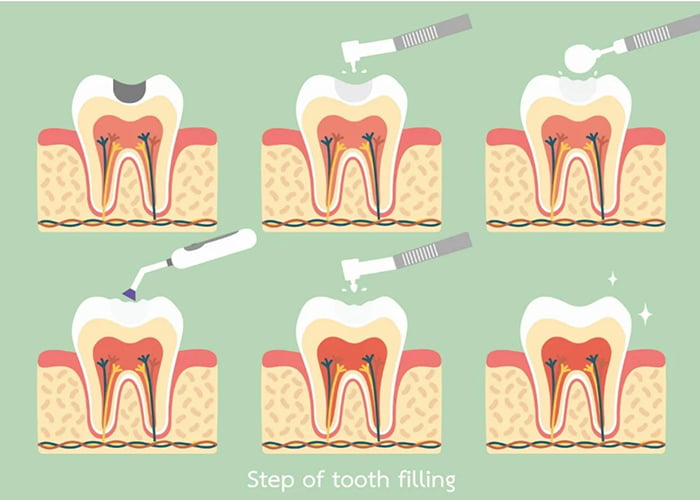Steps of a Dental Filling