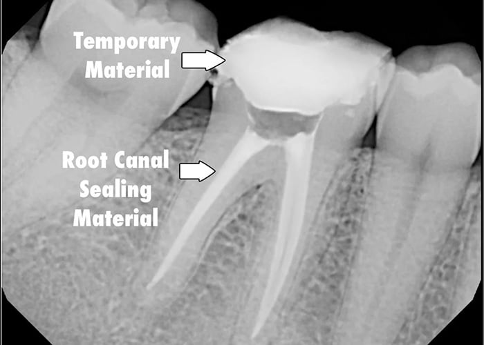 What's a Temporary Filling and Why Would I Need One?