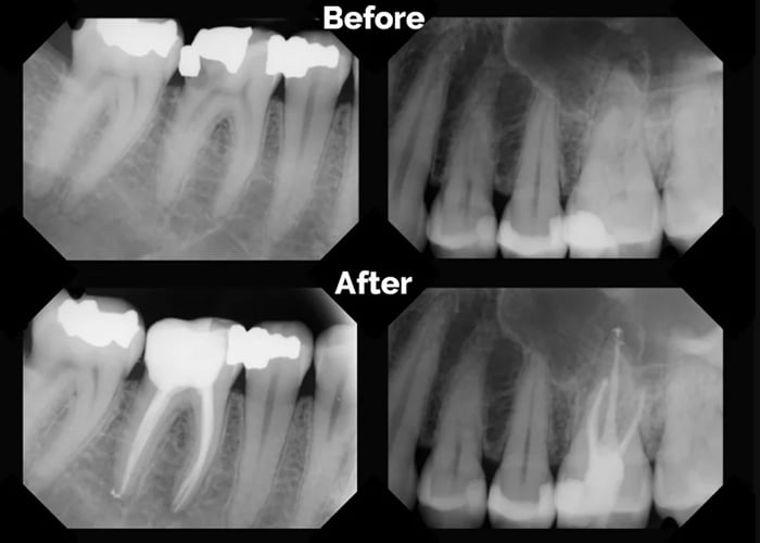 What is root canal treatment (therapy)?