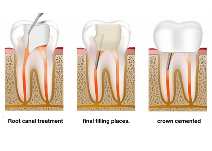 Steps of a root canal procedure
