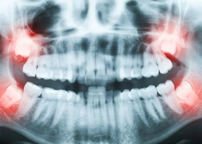 What is wisdom teeth extraction?