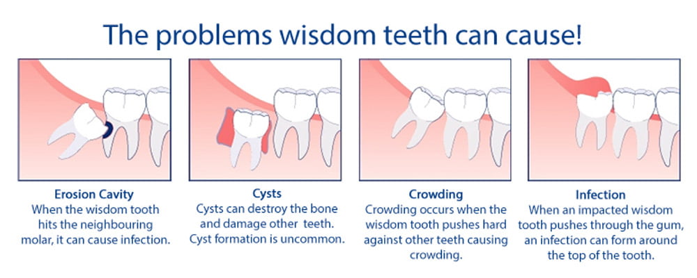 The problems wisdom teeth can cause