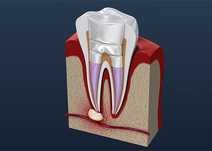 What's Included in Root Canal Costs?