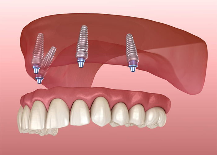 Implant-supported fixed dentures