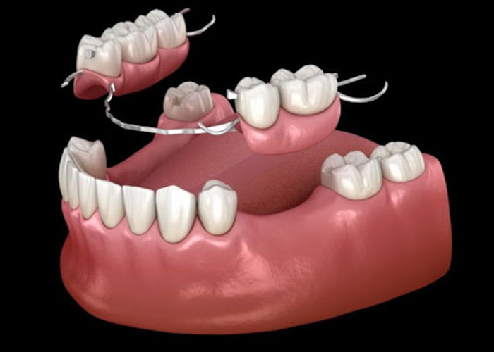 Everything You Need to Know About Partial Dentures