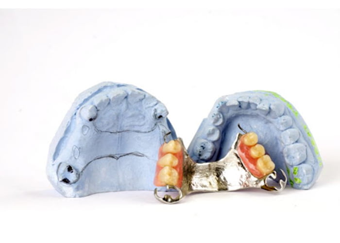 Cast Metal Partial Denture
