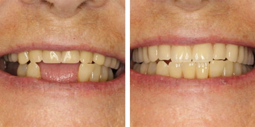 Acrylic Partial Denture To Replace Missing Teeth