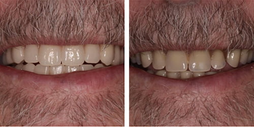 Updating worn and faded dentures