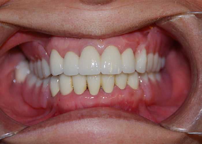 What Are the Symptoms of Denture Sores?