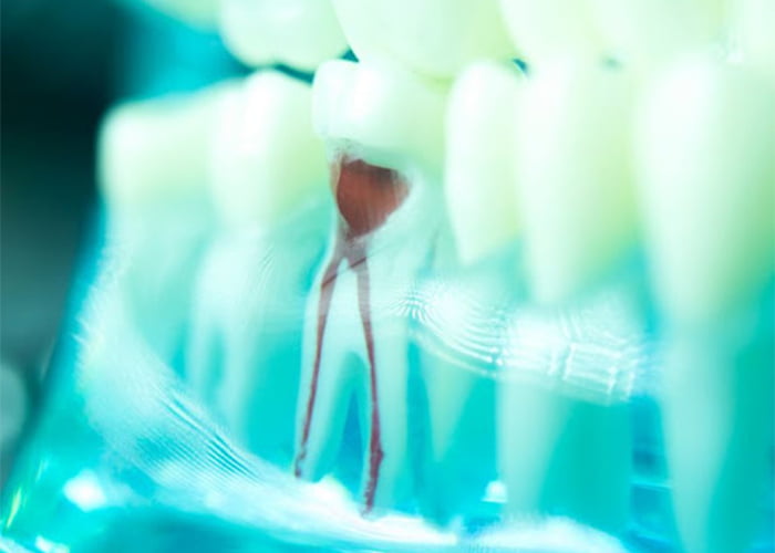 Why do root canals sometimes require two visits?