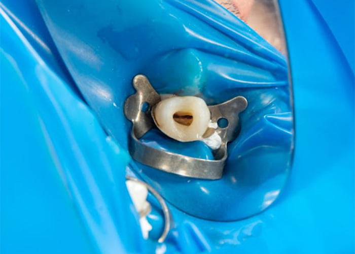 What’s involved in a root canal procedure?