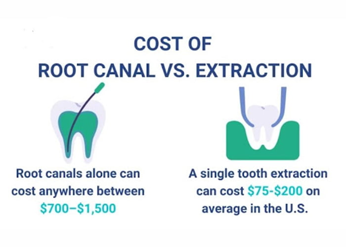 Root canal vs extraction price