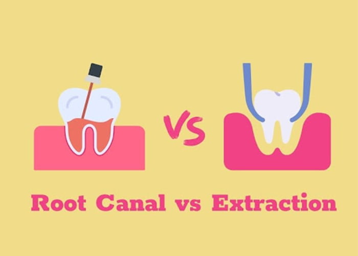 Root canal vs extraction