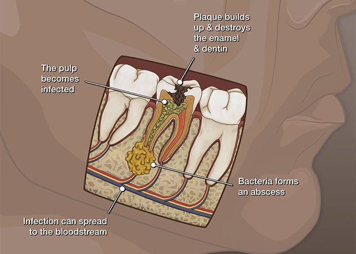 What causes root canal infections?