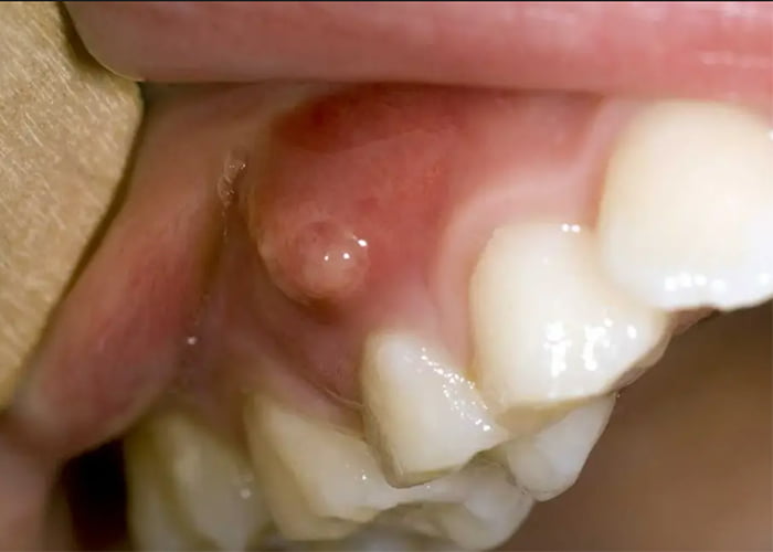 Persistent or Reoccurring Pimples on the Gums