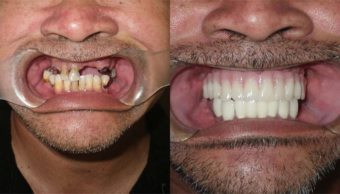Snap on dentures