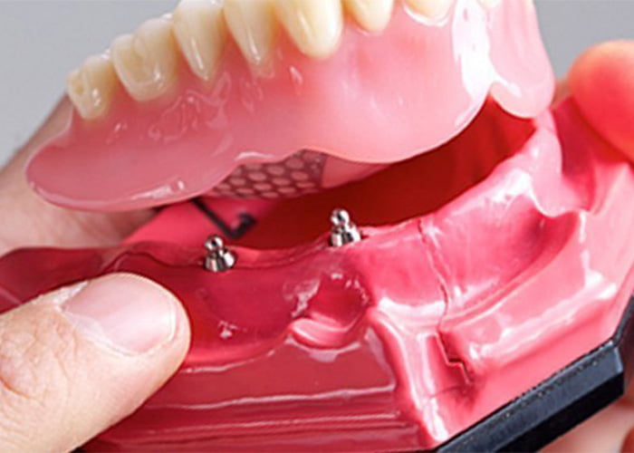 Disadvantages of Snap-On Dentures