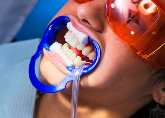 Does Teeth Whitening Damage Gums?