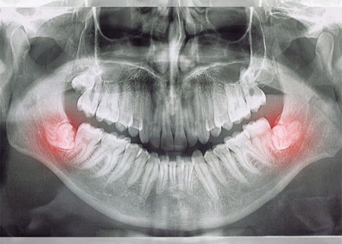 What You Need To Know As The Wisdom Teeth Come In
