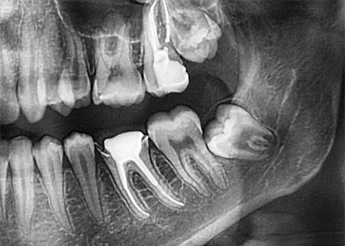 Why Do We Have Wisdom Teeth?
