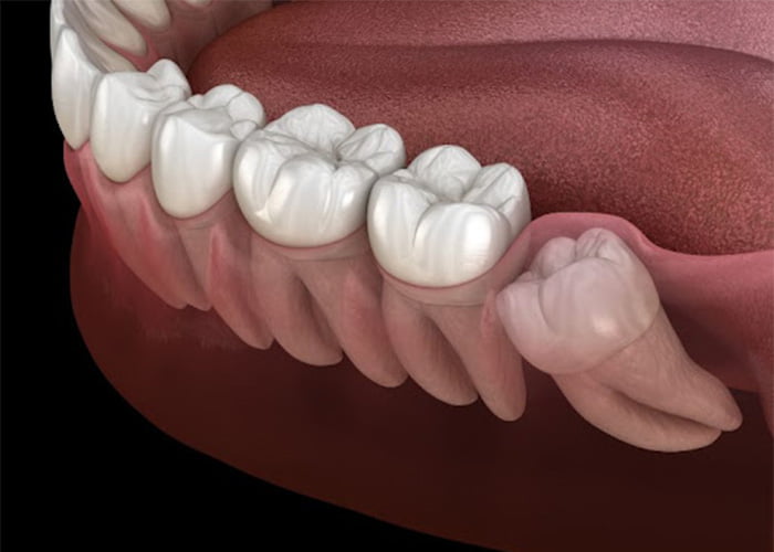 What does it feel like to have your wisdom teeth come in?