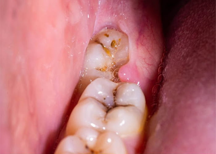 Infection In The Gums while wisdom teeth coming in