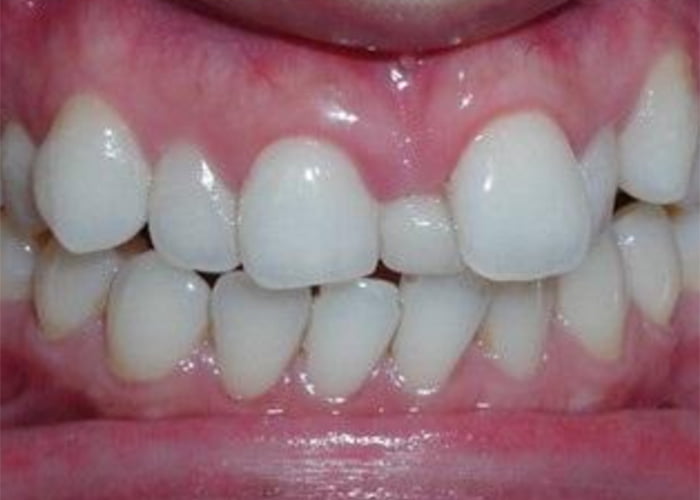 Correction of misshapen teeth - Before