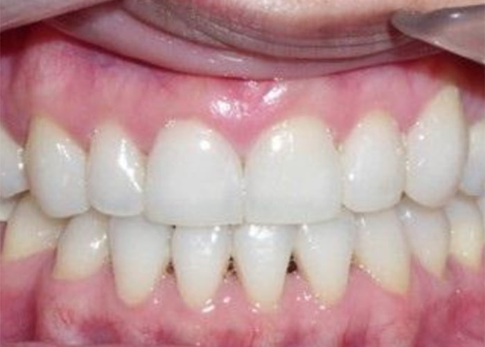 Correction of misshapen teeth - After